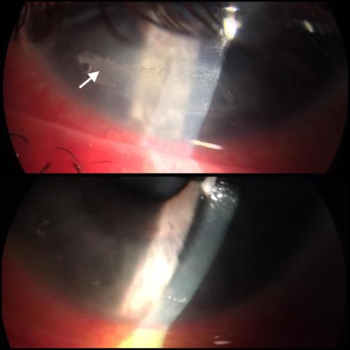 Corneal defect after prolonged ventilation on the intensive care unit - before and after treatment